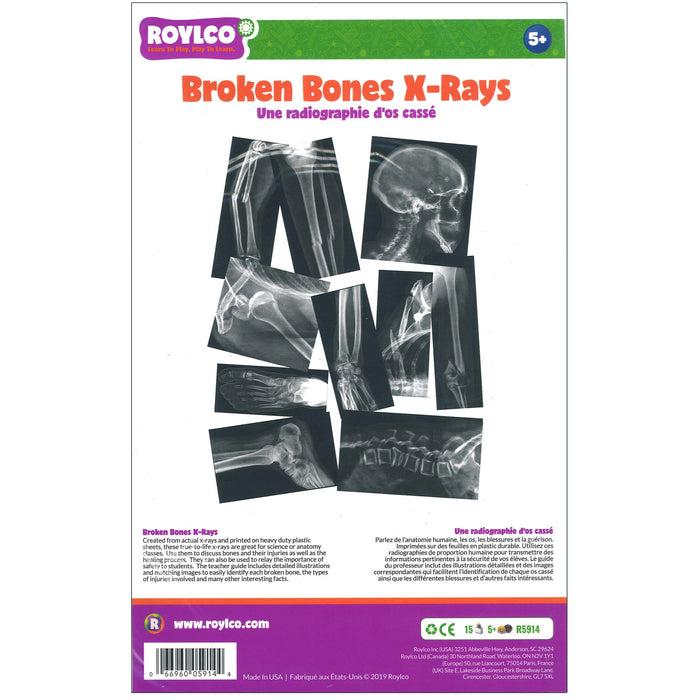 BROKEN BONES X-RAYS